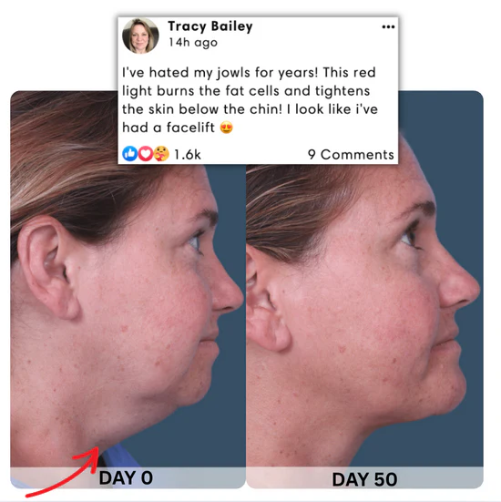 Chin Lifting Therapy