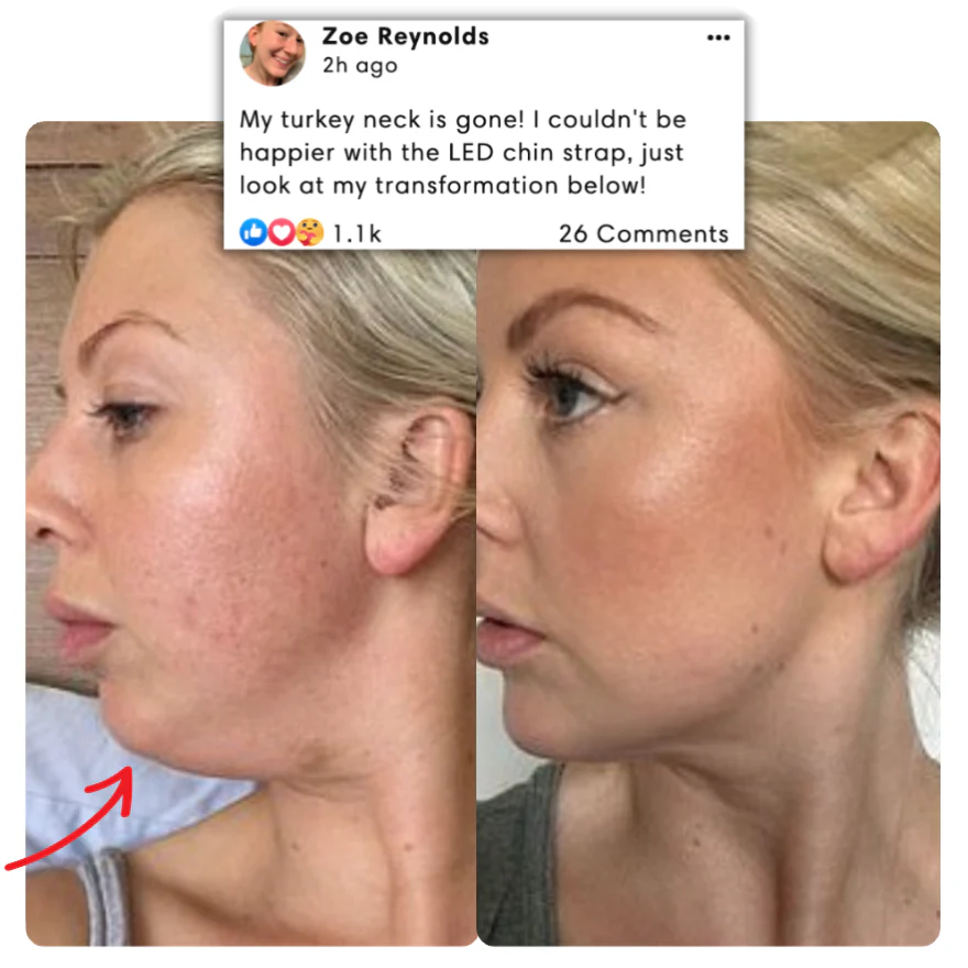 Chin Lifting Therapy