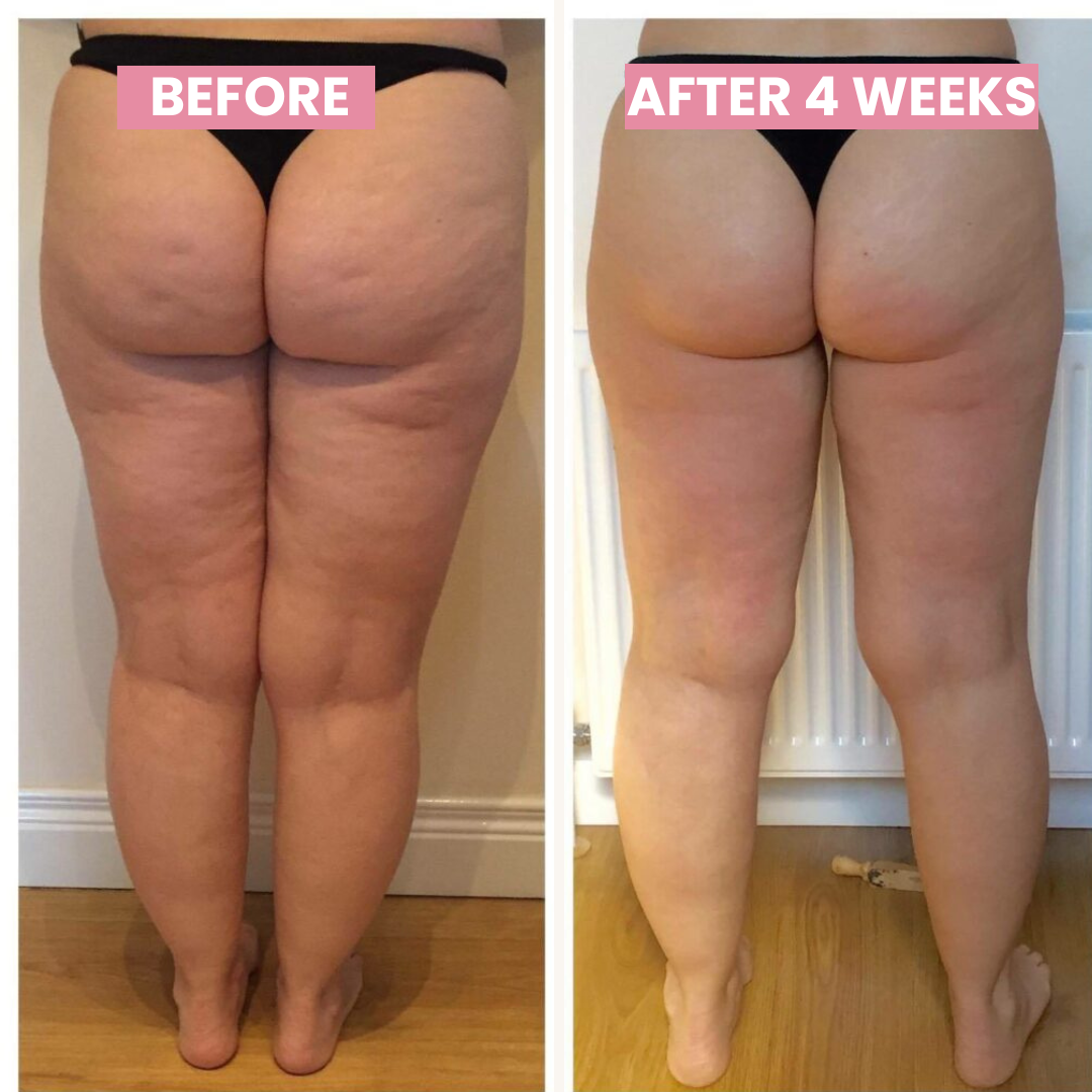 Lyxori™ Cellulite Relief Kit